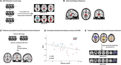 Progressive Brain Structural Impairment Assessed via Network and Causal Analysis in Patients With Hepatitis B Virus-Related Cirrhosis